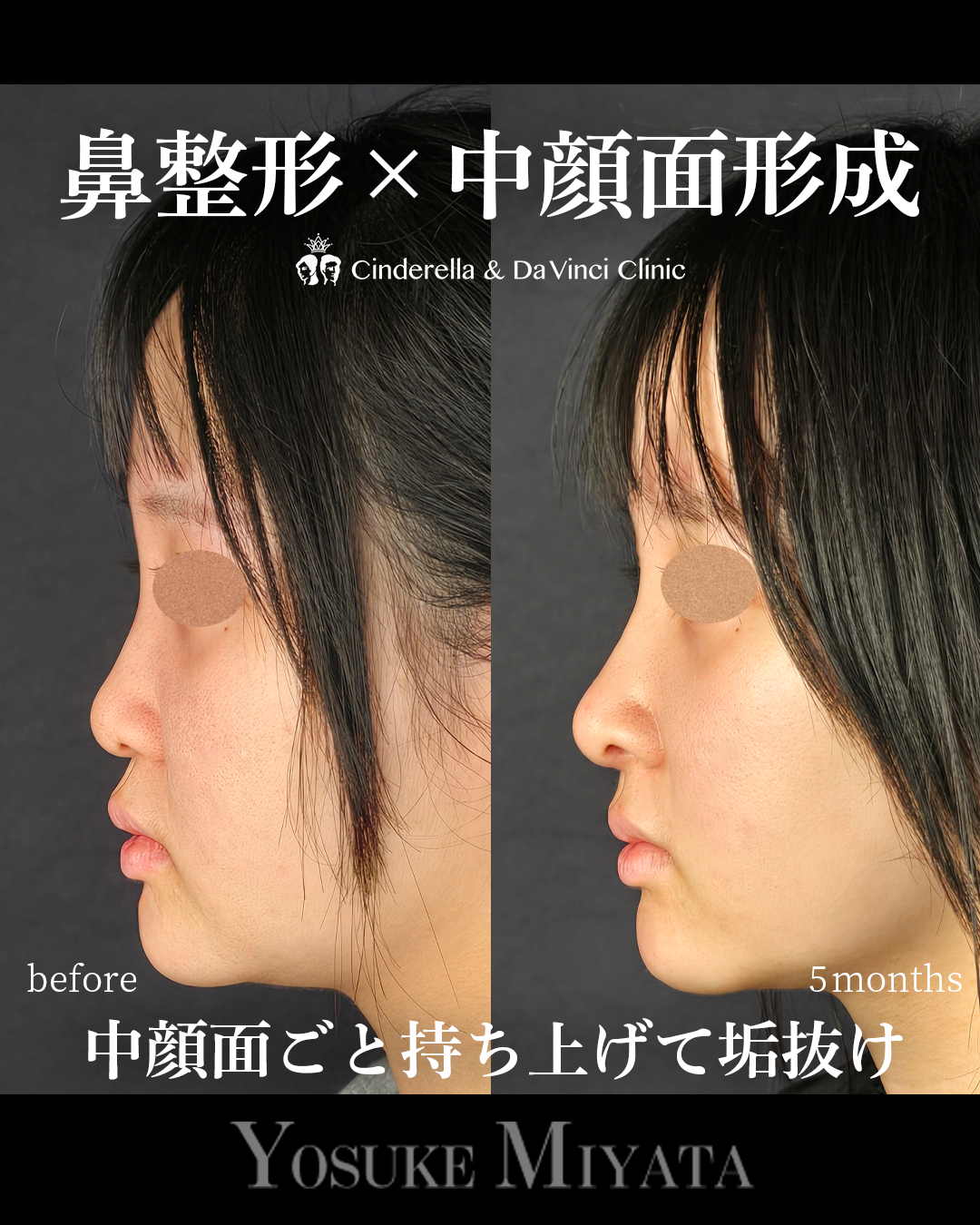 中顔面形成の画像