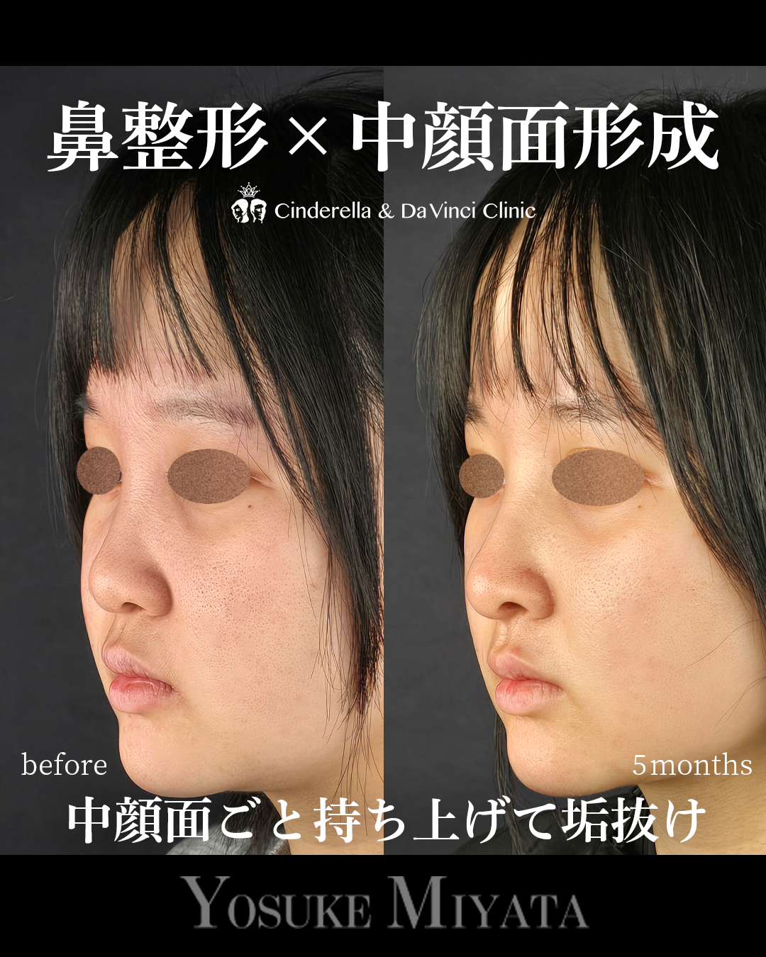 中顔面形成の画像