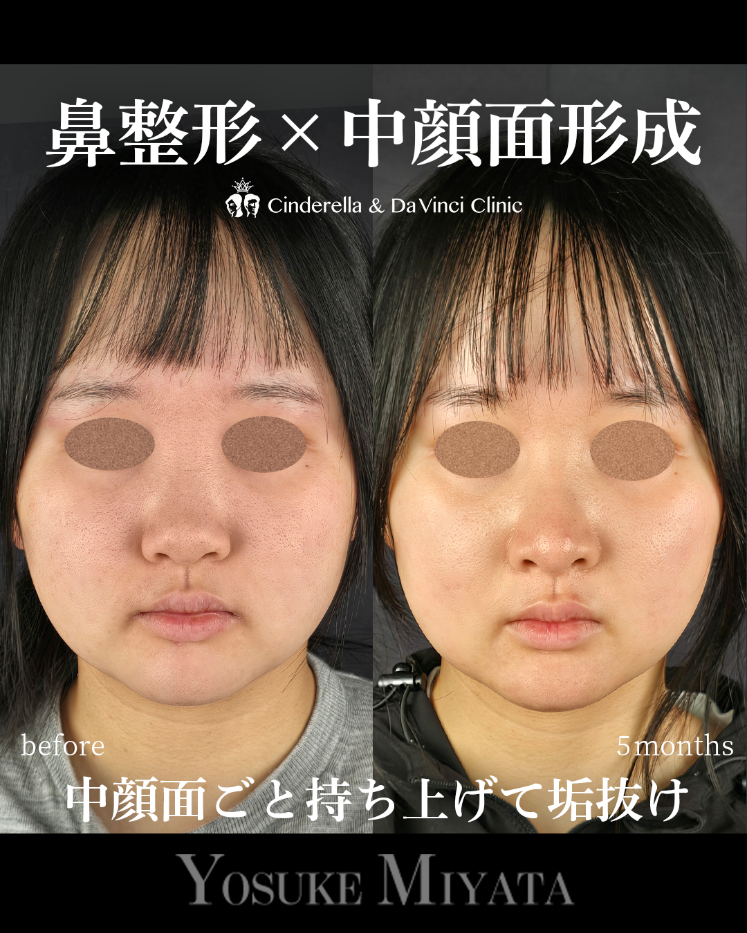 中顔面形成の画像