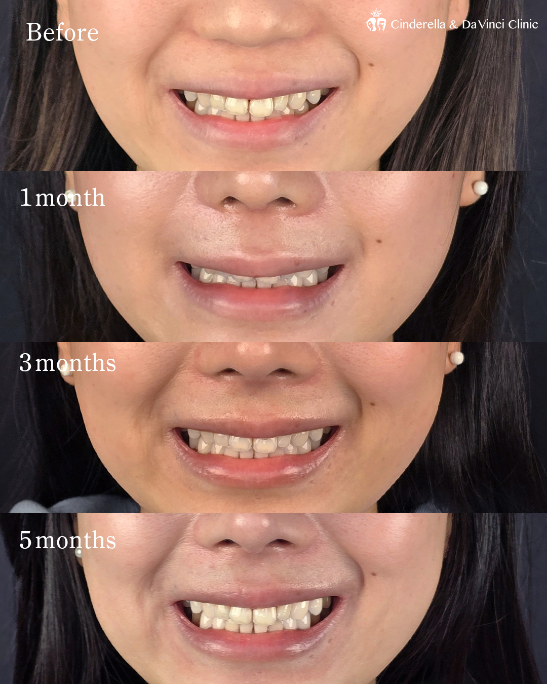 肋軟骨を使った鼻フルの画像