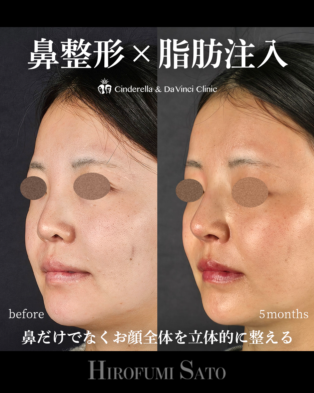 鼻整形と脂肪注入同時の画像