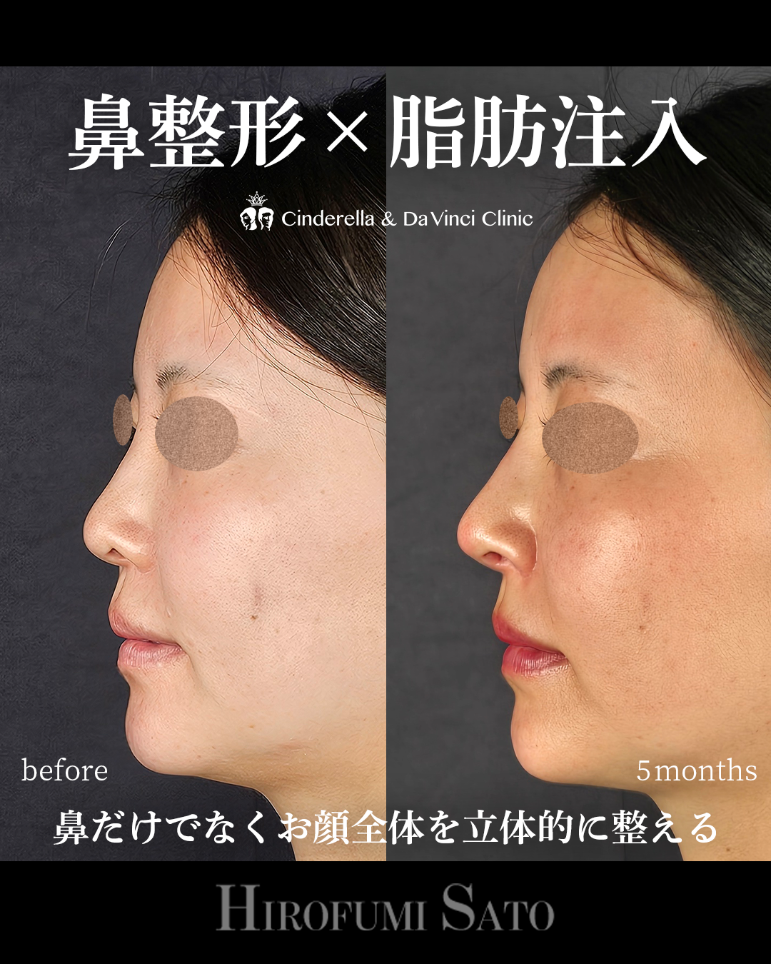 鼻整形と脂肪注入同時の画像