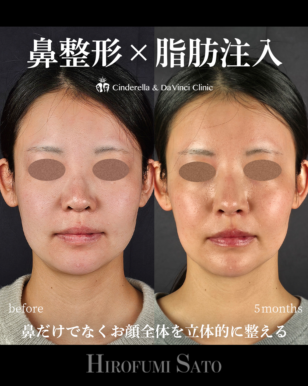 鼻整形と脂肪注入同時の画像