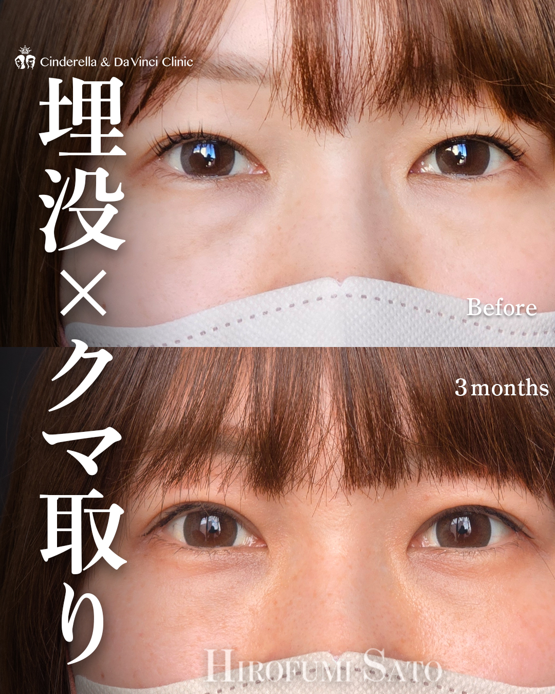 埋没×クマ取り