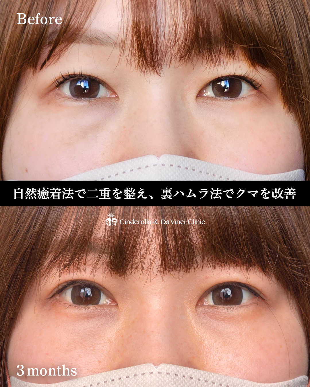 埋没×クマ取りの画像