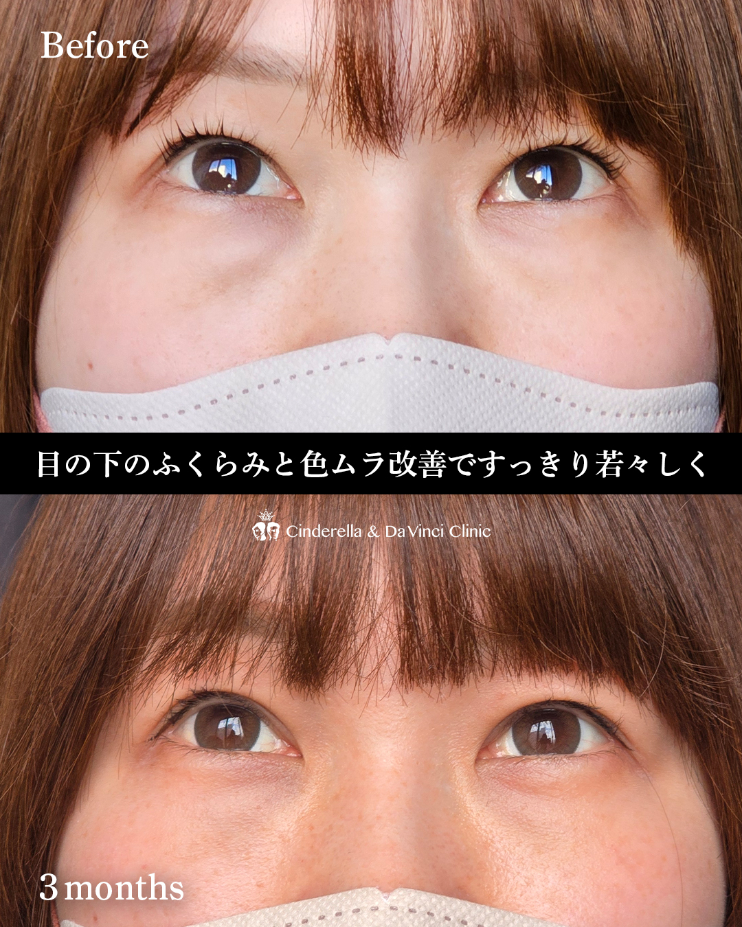 埋没×クマ取りの画像