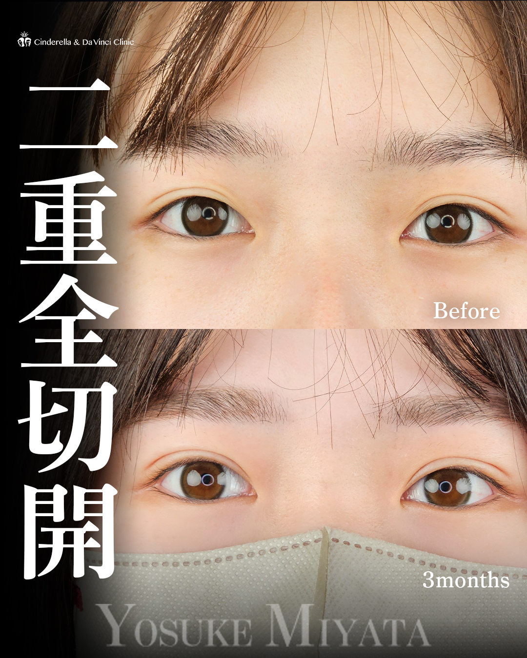 埋没から切開への画像