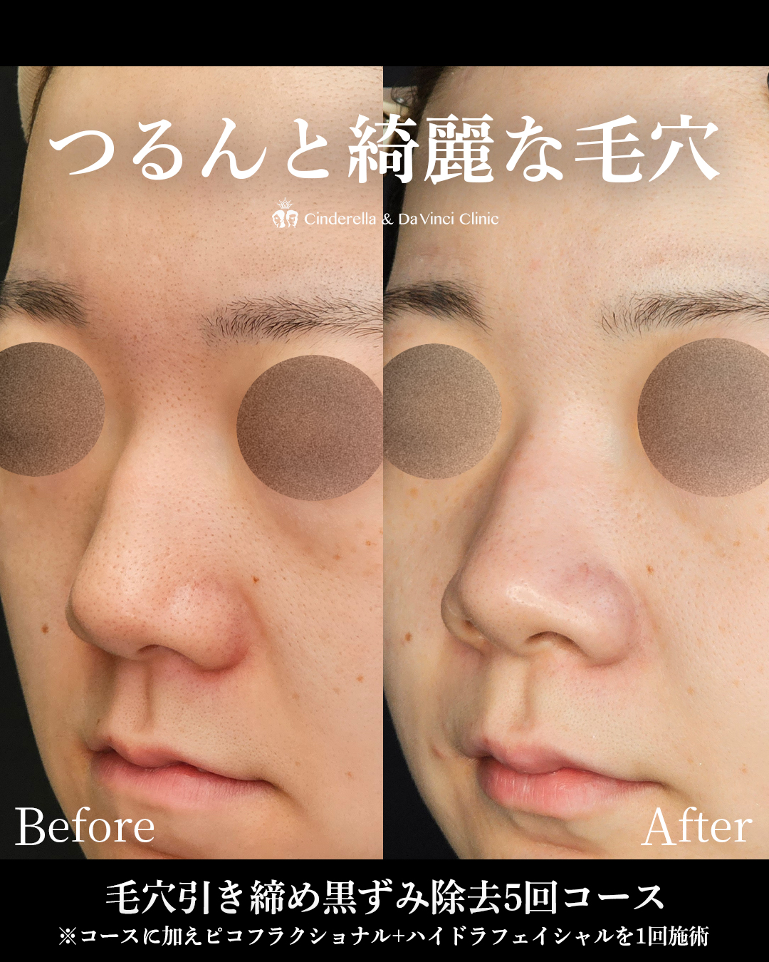 綺麗な毛穴にの画像