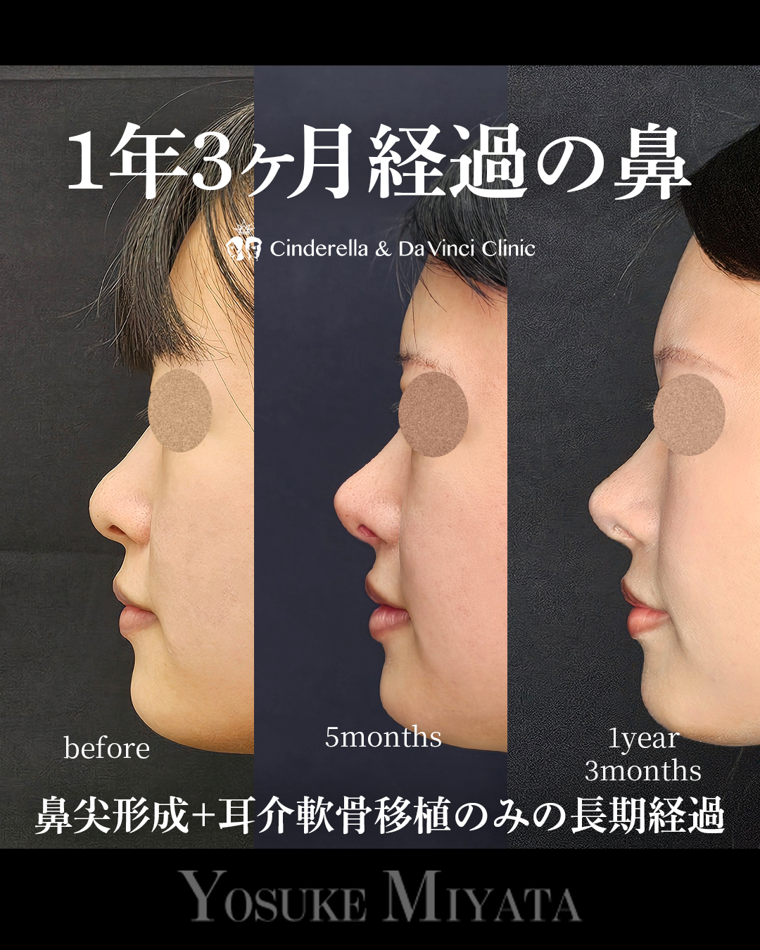 1年3ヶ月経過の鼻の画像