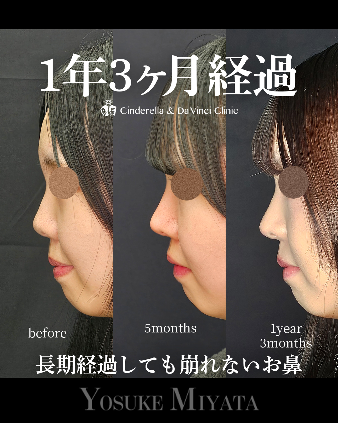 お鼻の長期経過の画像