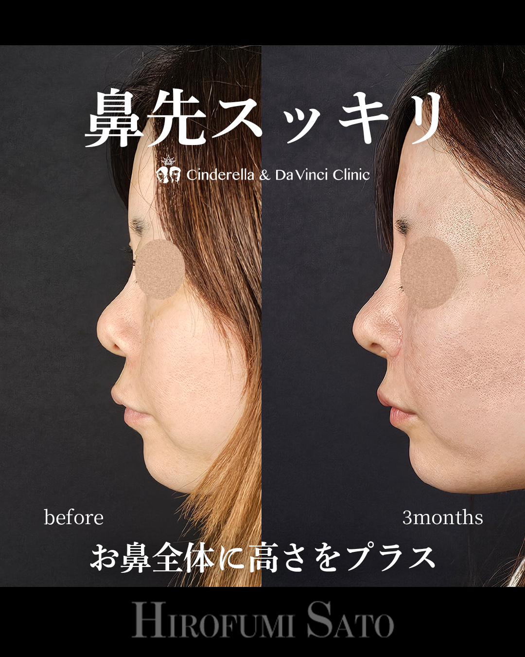 鼻先スッキリの画像