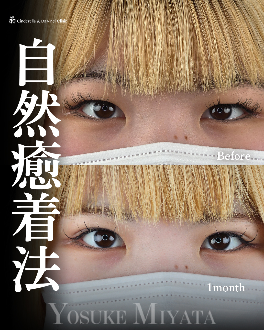 ナチュラル二重