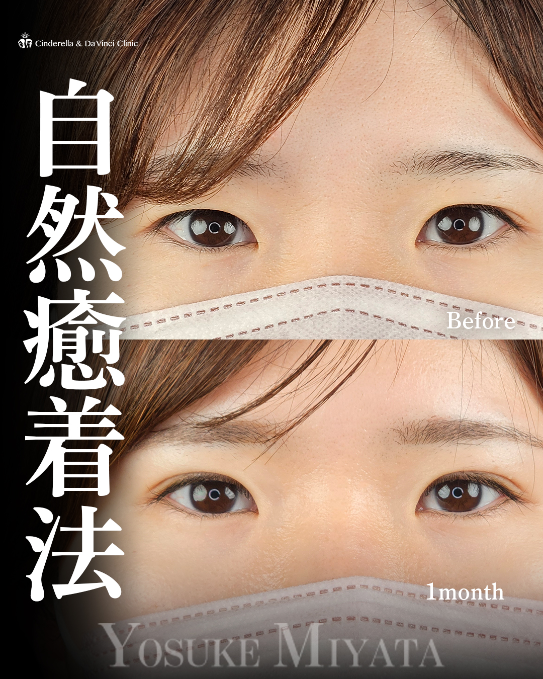 末広二重の画像