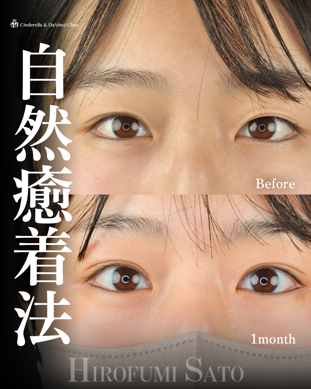 自然で綺麗な二重の画像