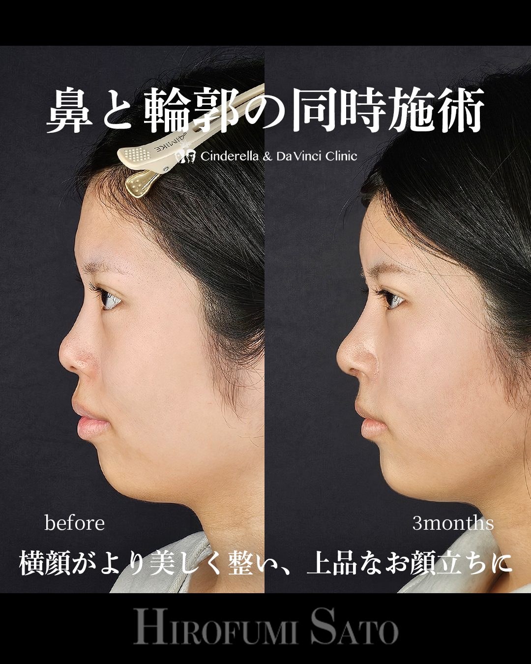 鼻+輪郭の同時施術の画像