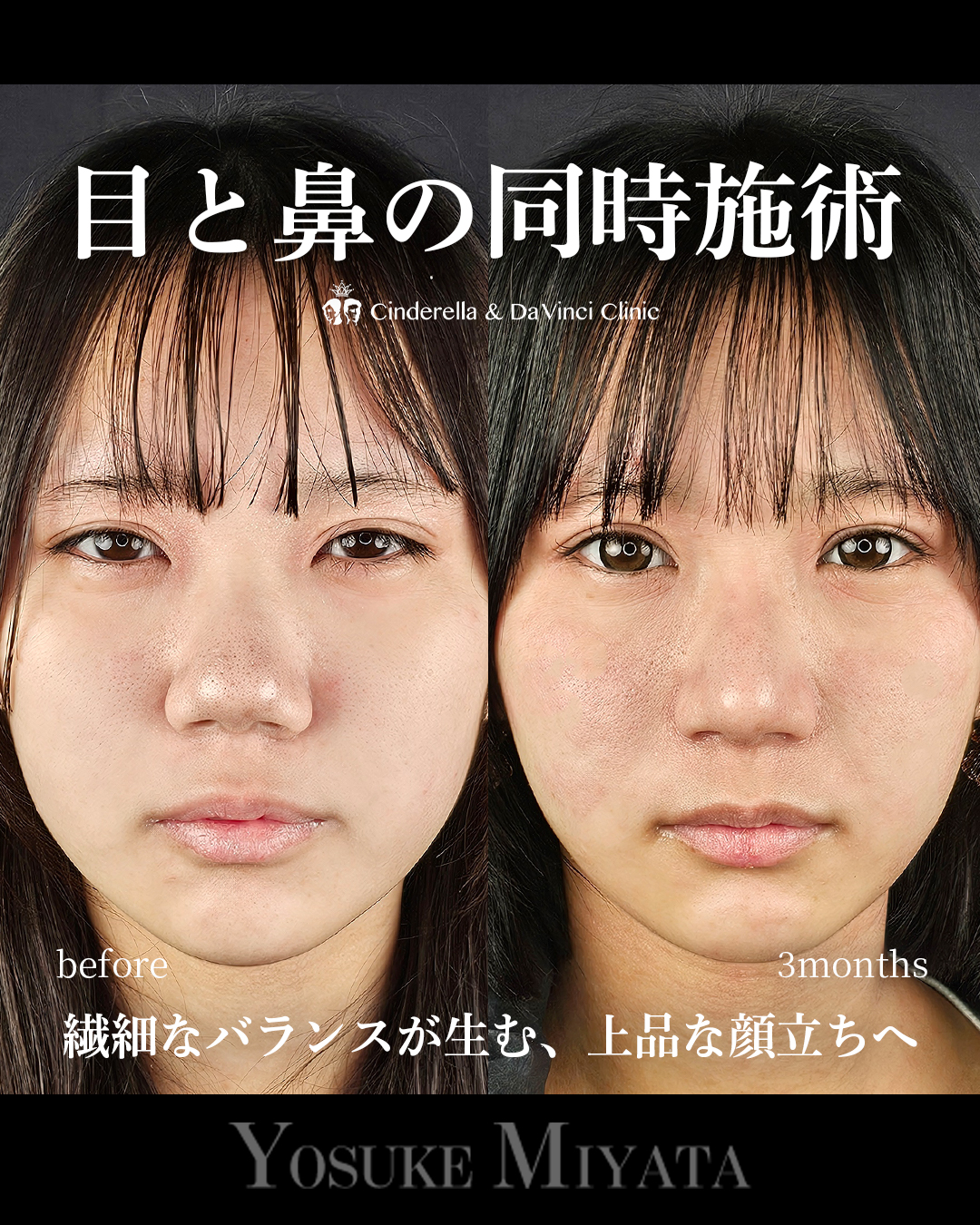 目と鼻の同時施術の画像