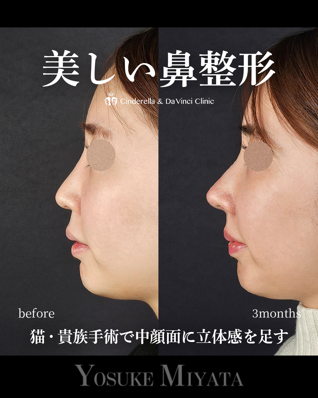 美しい鼻整形の画像