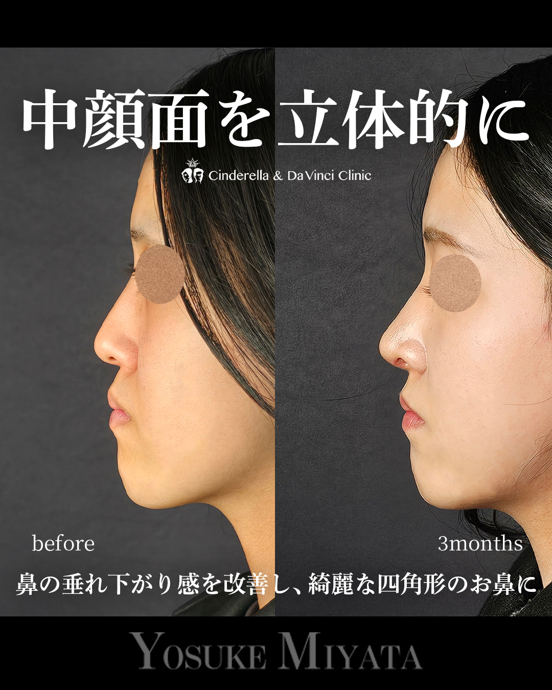 中顔面を立体的にの画像