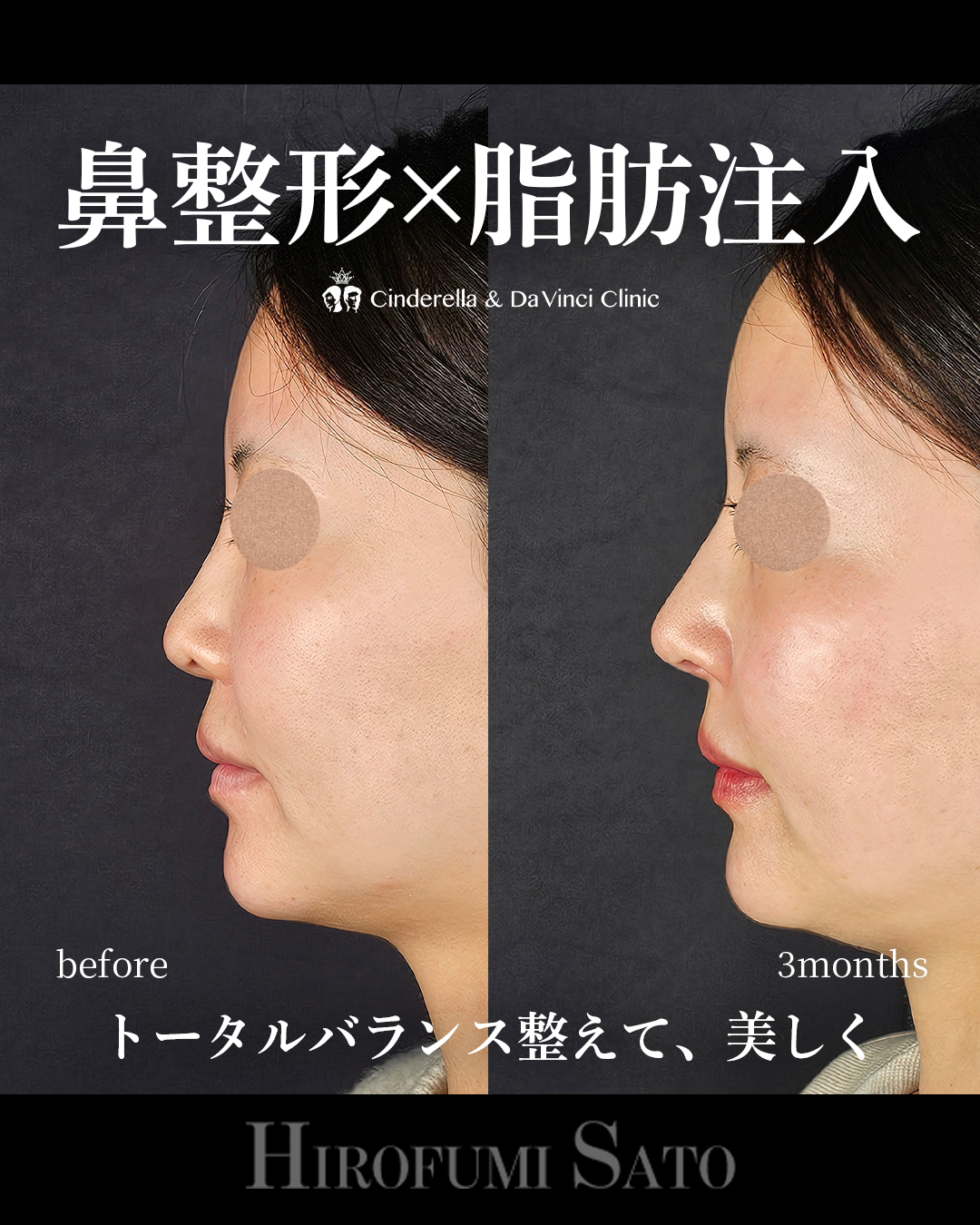 鼻整形と脂肪注入同時の画像