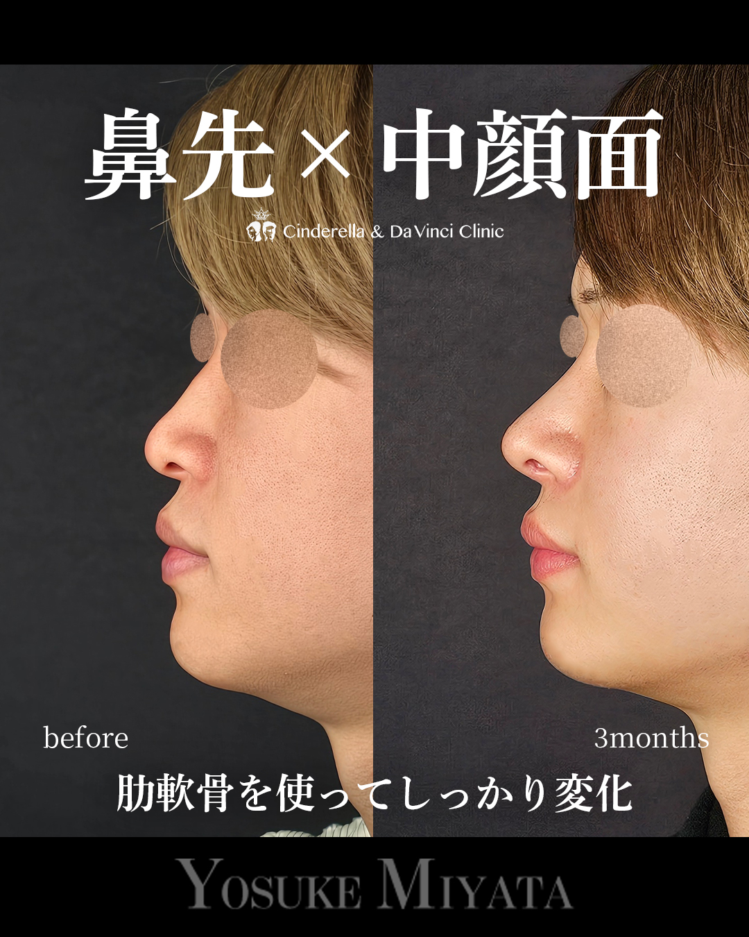 肋軟骨の鼻フルの画像