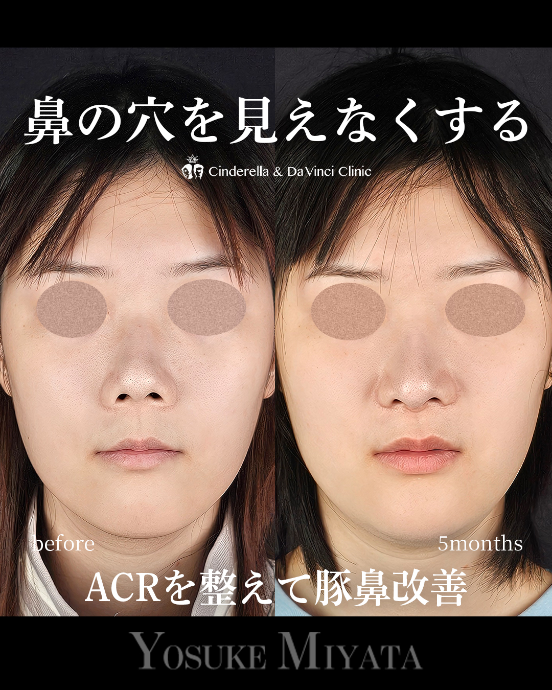 鼻の穴を見えなくするの画像