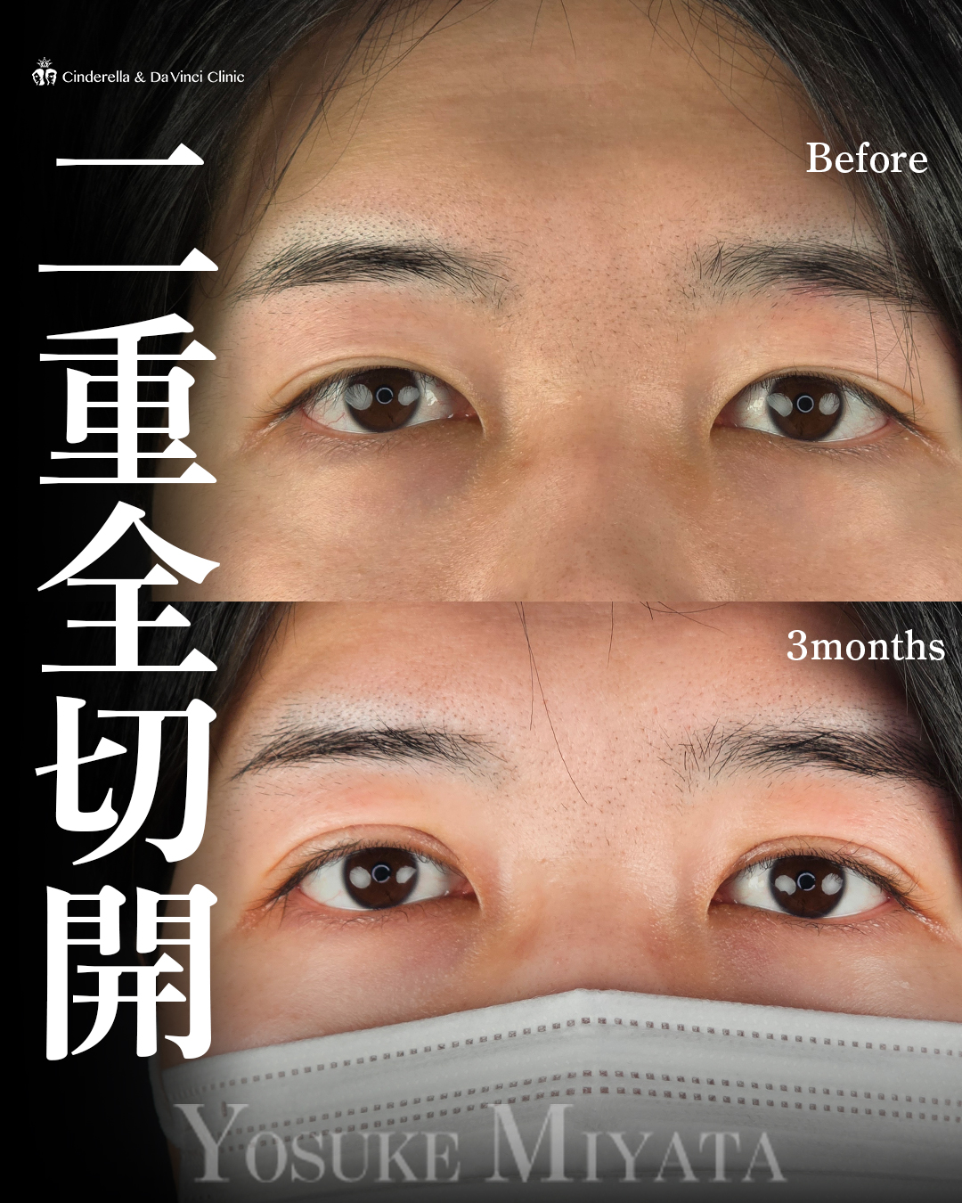 男性の二重切開の画像