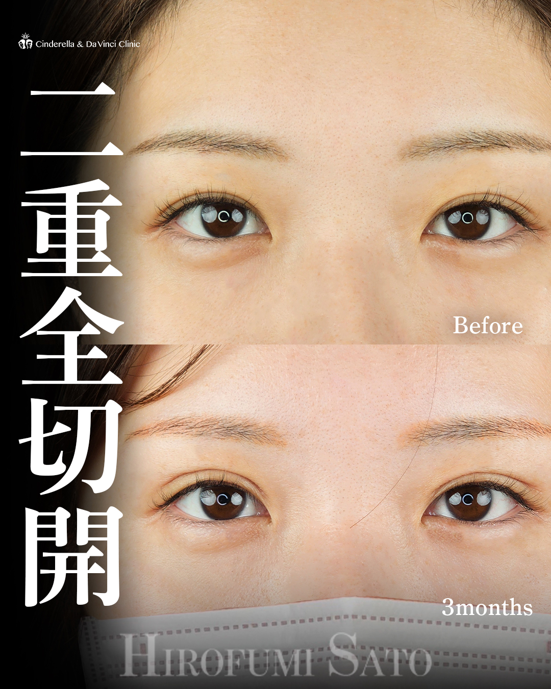 華やかな二重にの画像