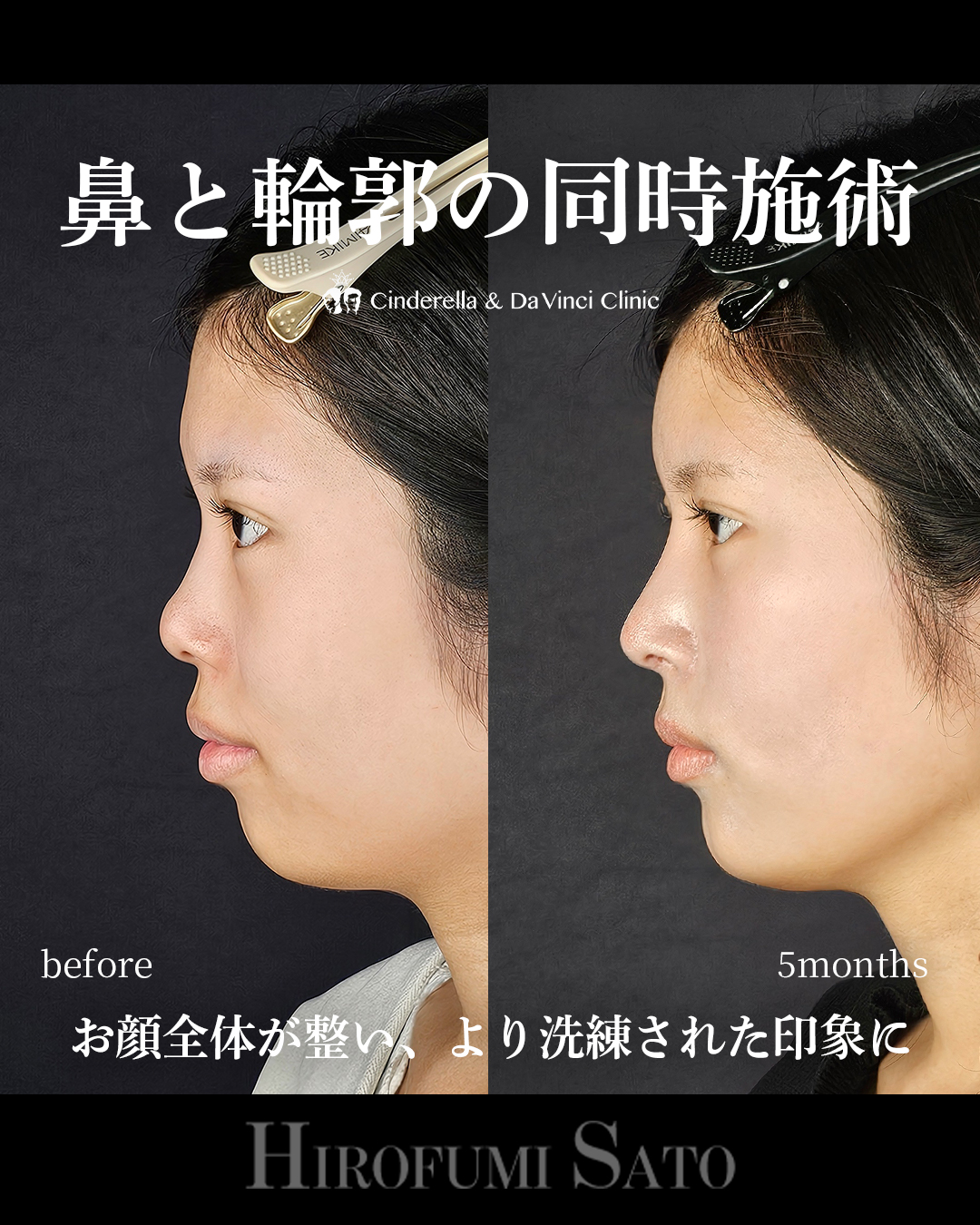 鼻+輪郭の同時施術の画像