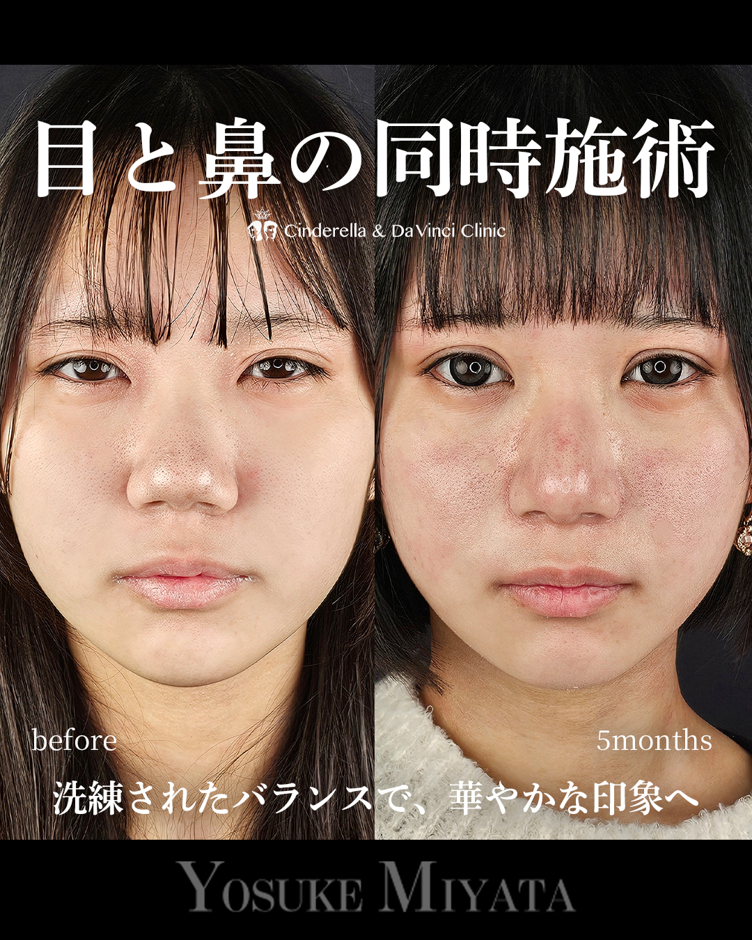 目と鼻の同時施術の画像