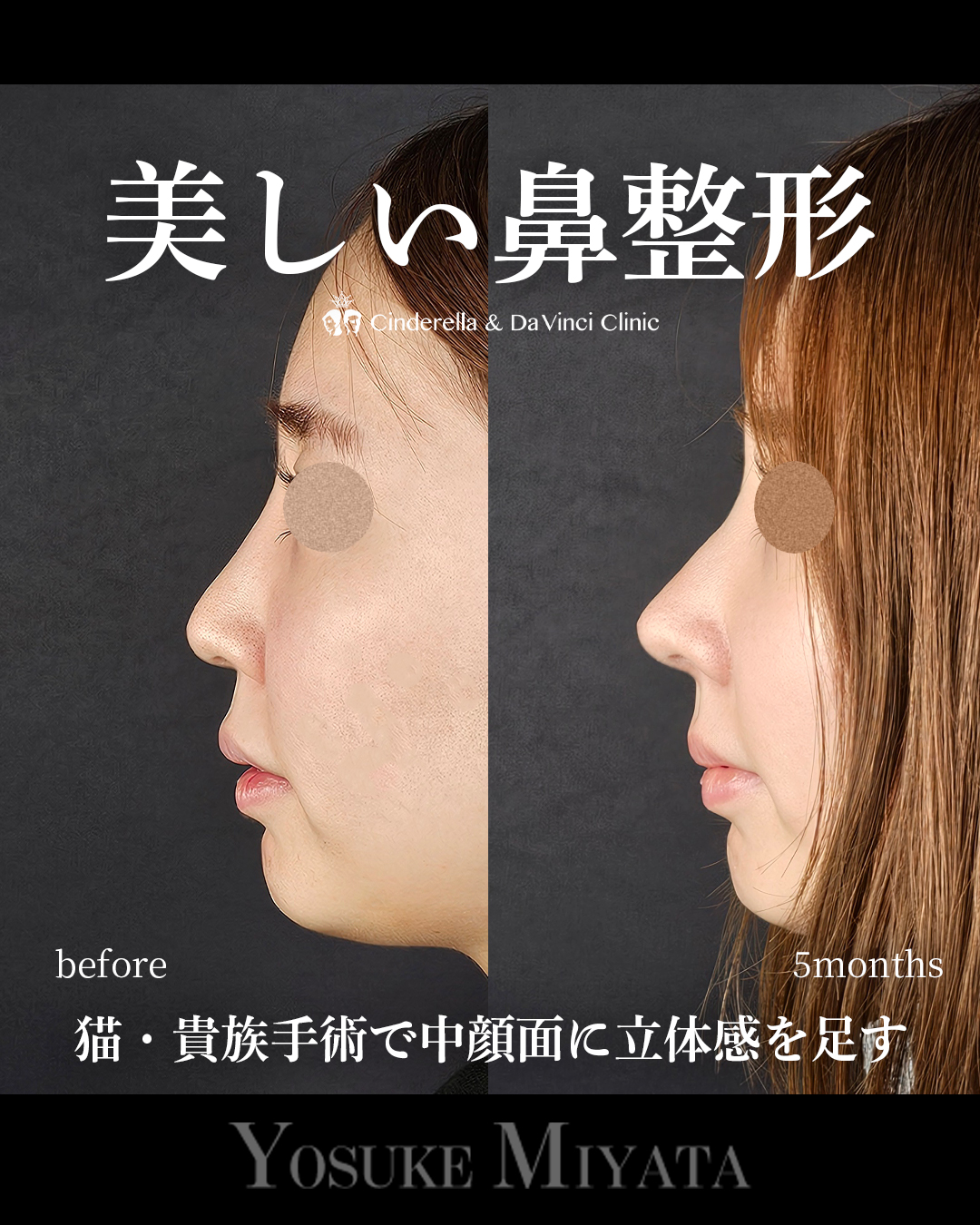 美しい鼻整形の画像
