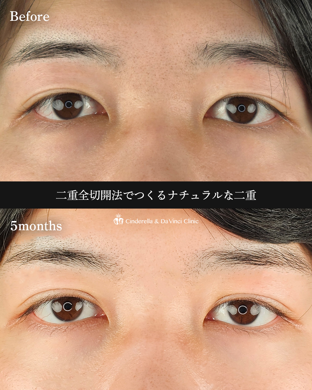 男性の二重切開の画像