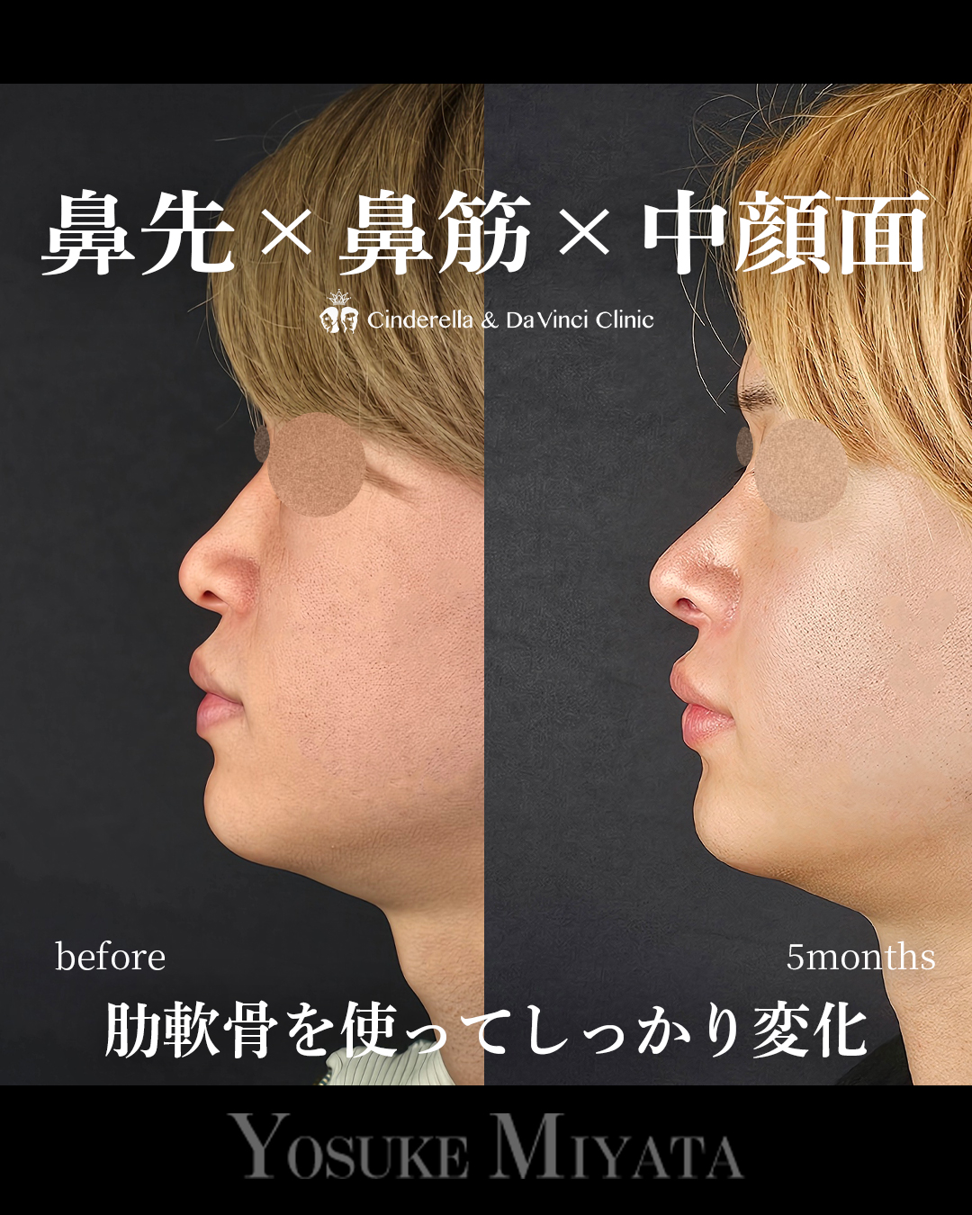 肋軟骨の鼻フルの画像