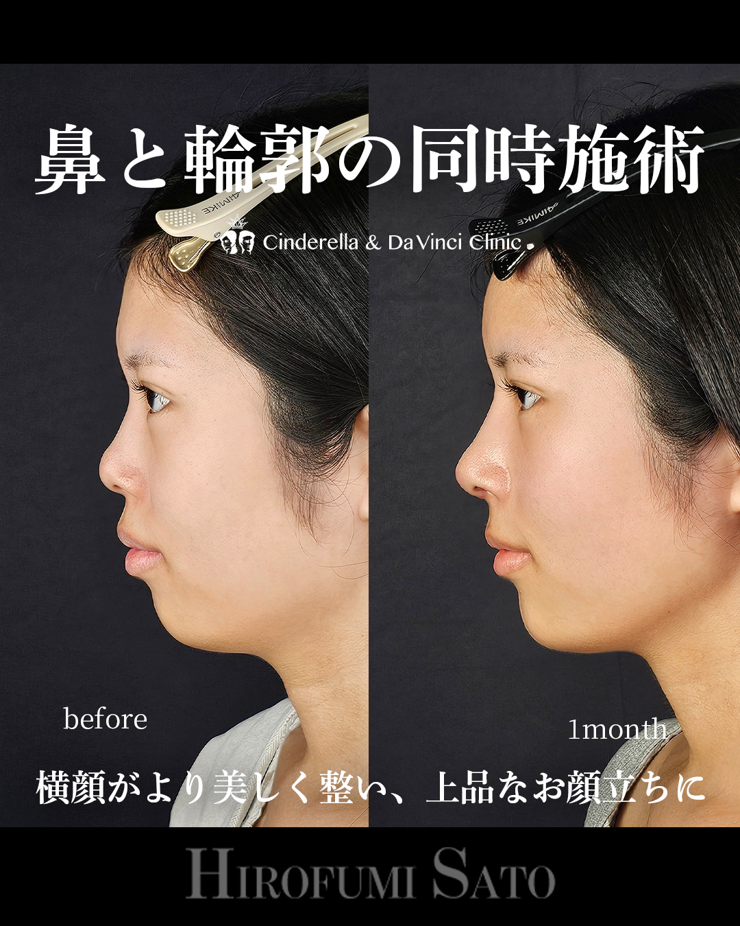 鼻+輪郭の同時施術の画像