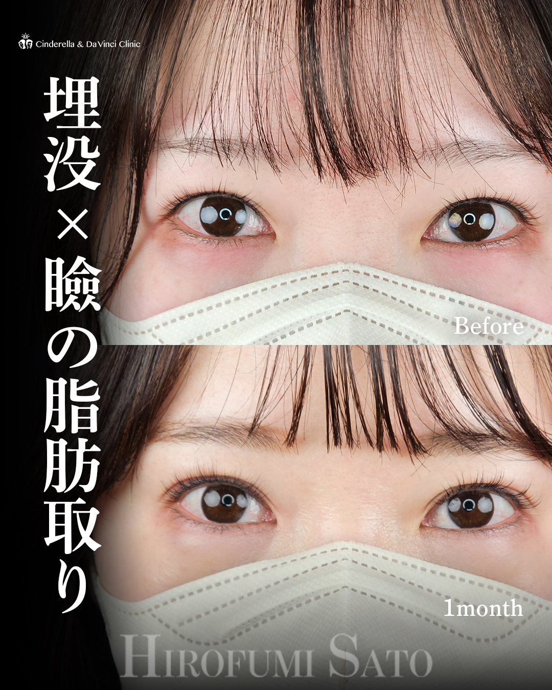 埋没×脂肪取りの画像