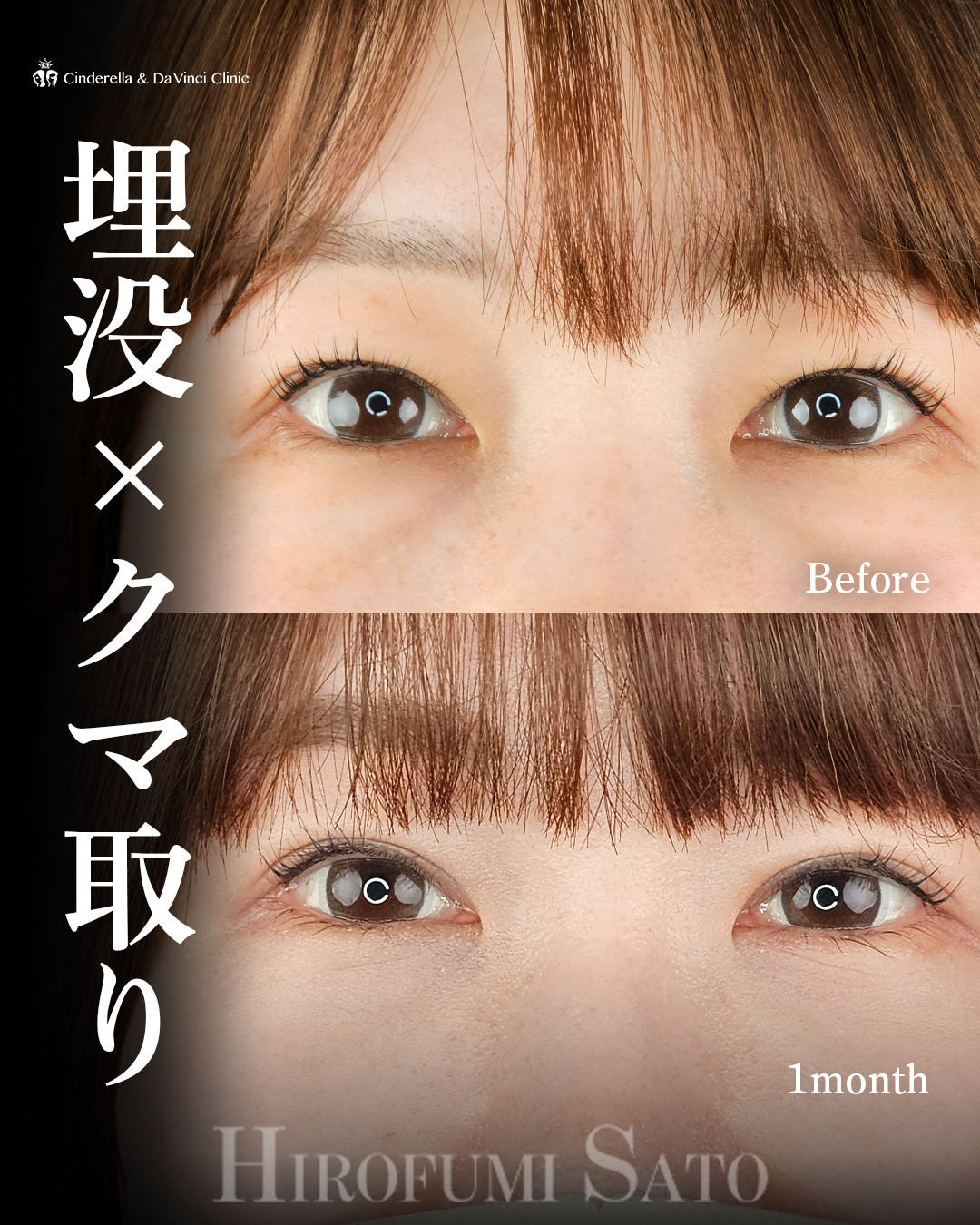 埋没×クマ取りの画像