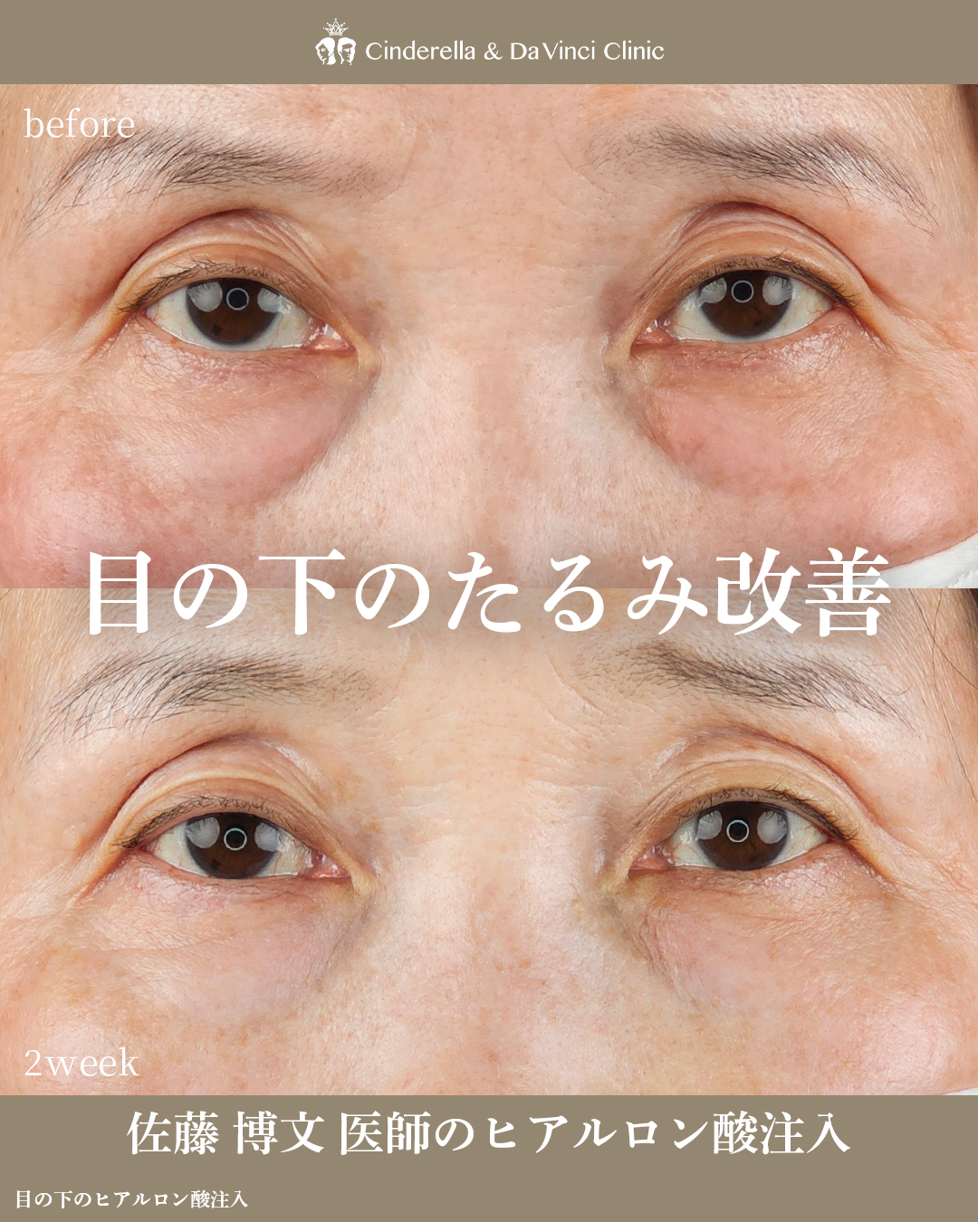 目の下のたるみ改善の画像