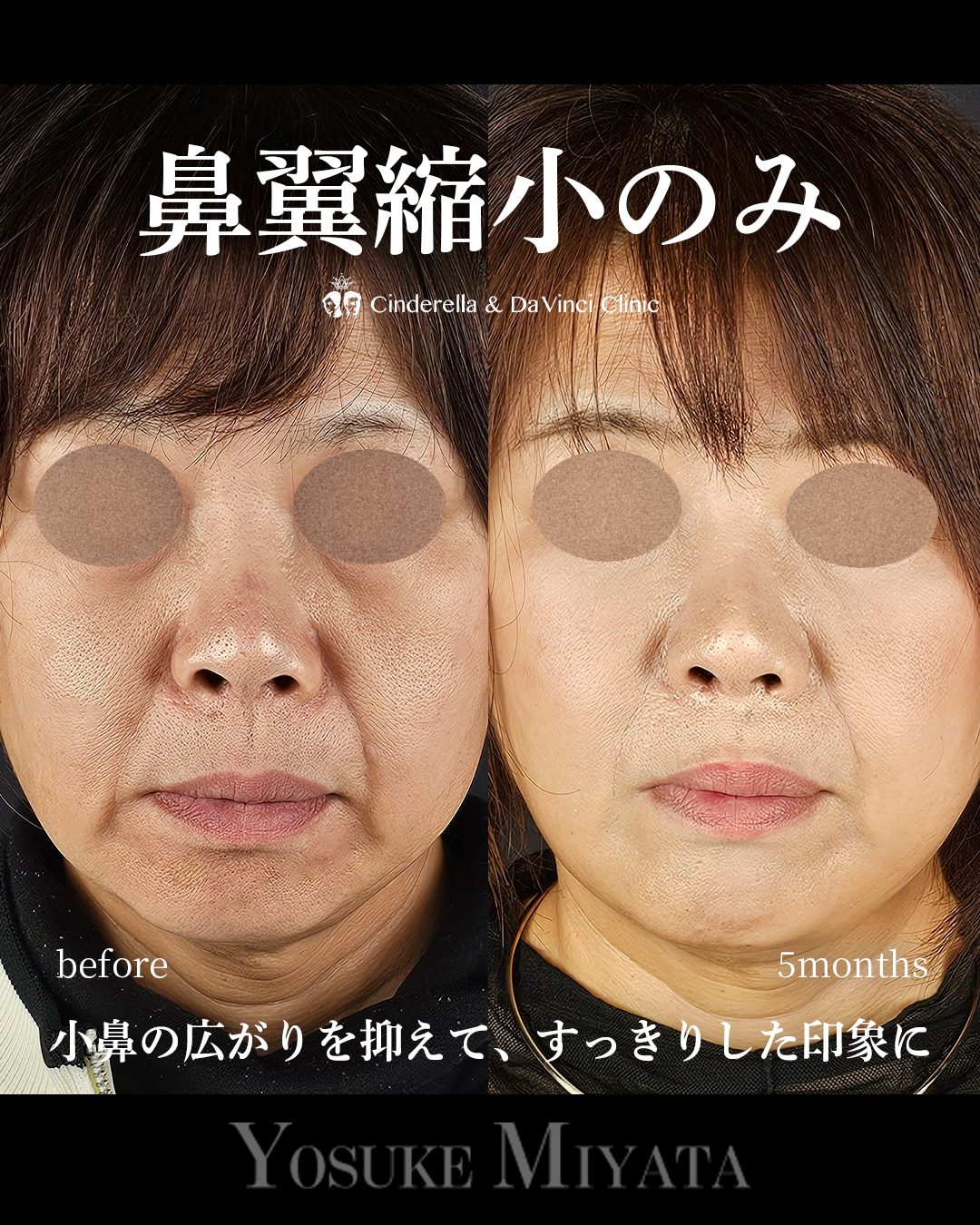 鼻翼縮小のみの画像