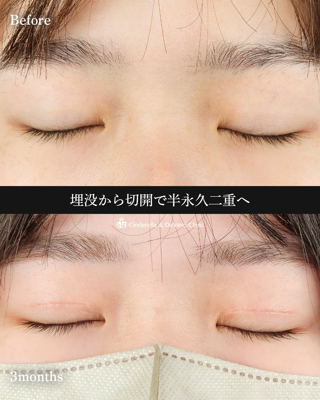 埋没から切開への画像