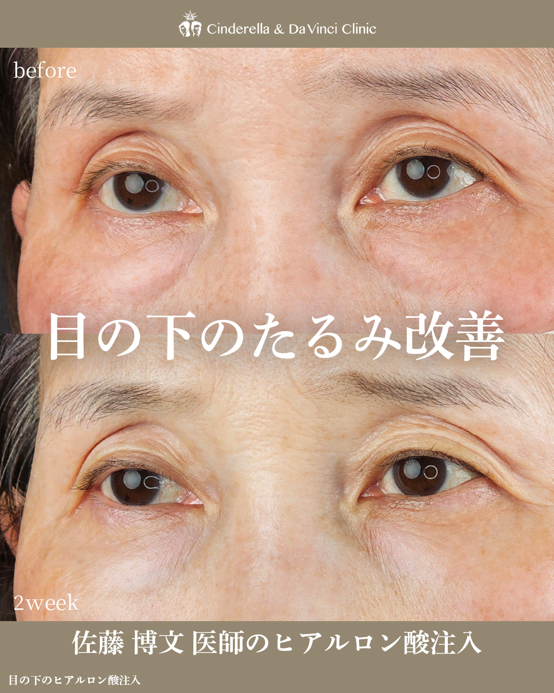 目の下のたるみ改善の画像