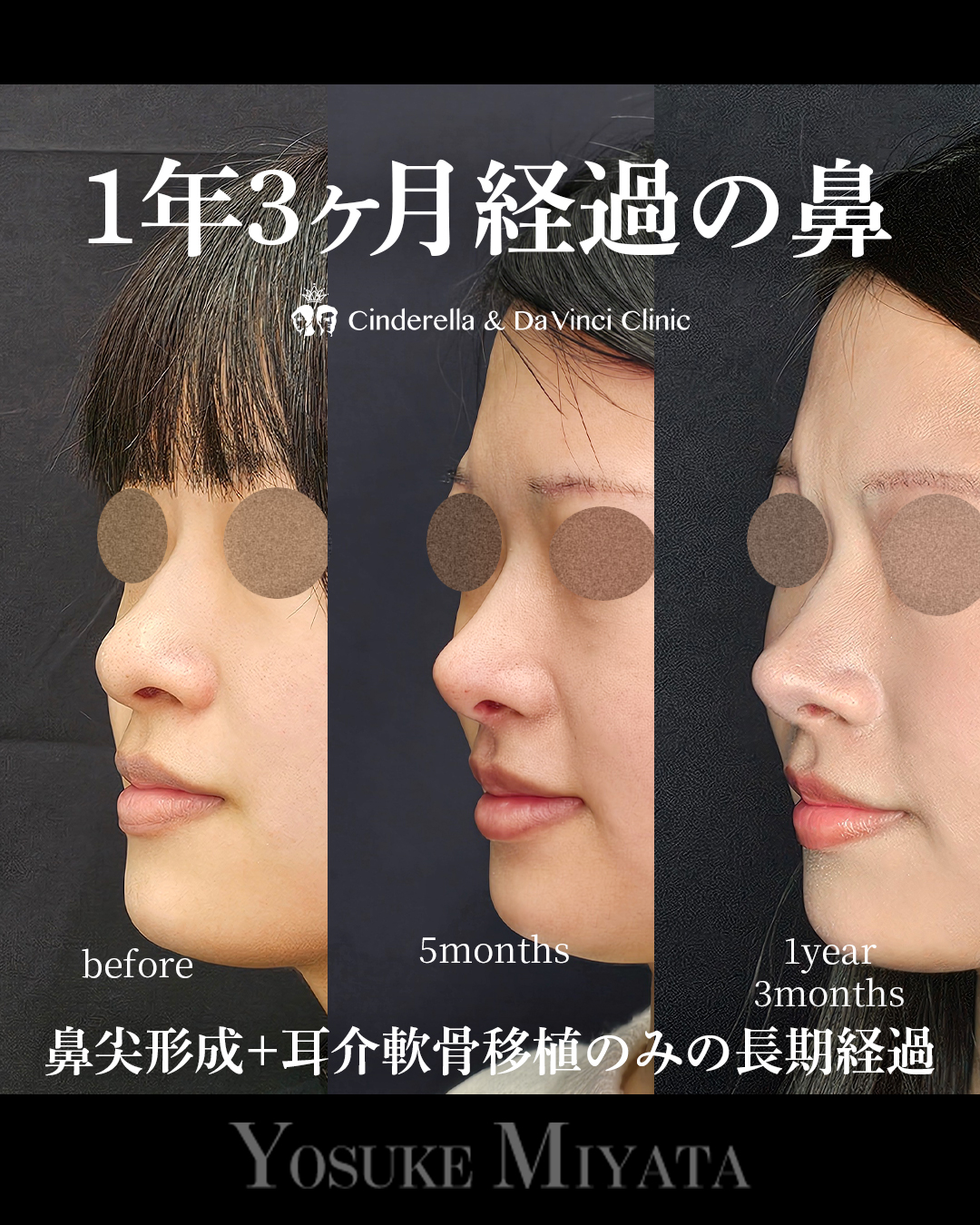 1年3ヶ月経過の鼻の画像