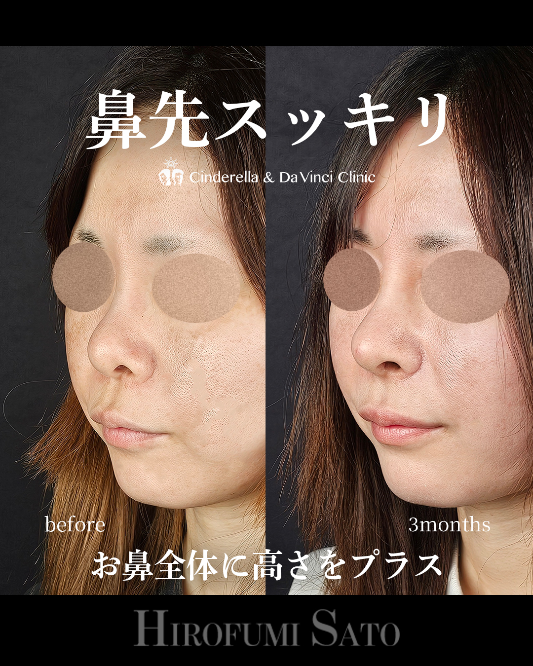 鼻先スッキリの画像