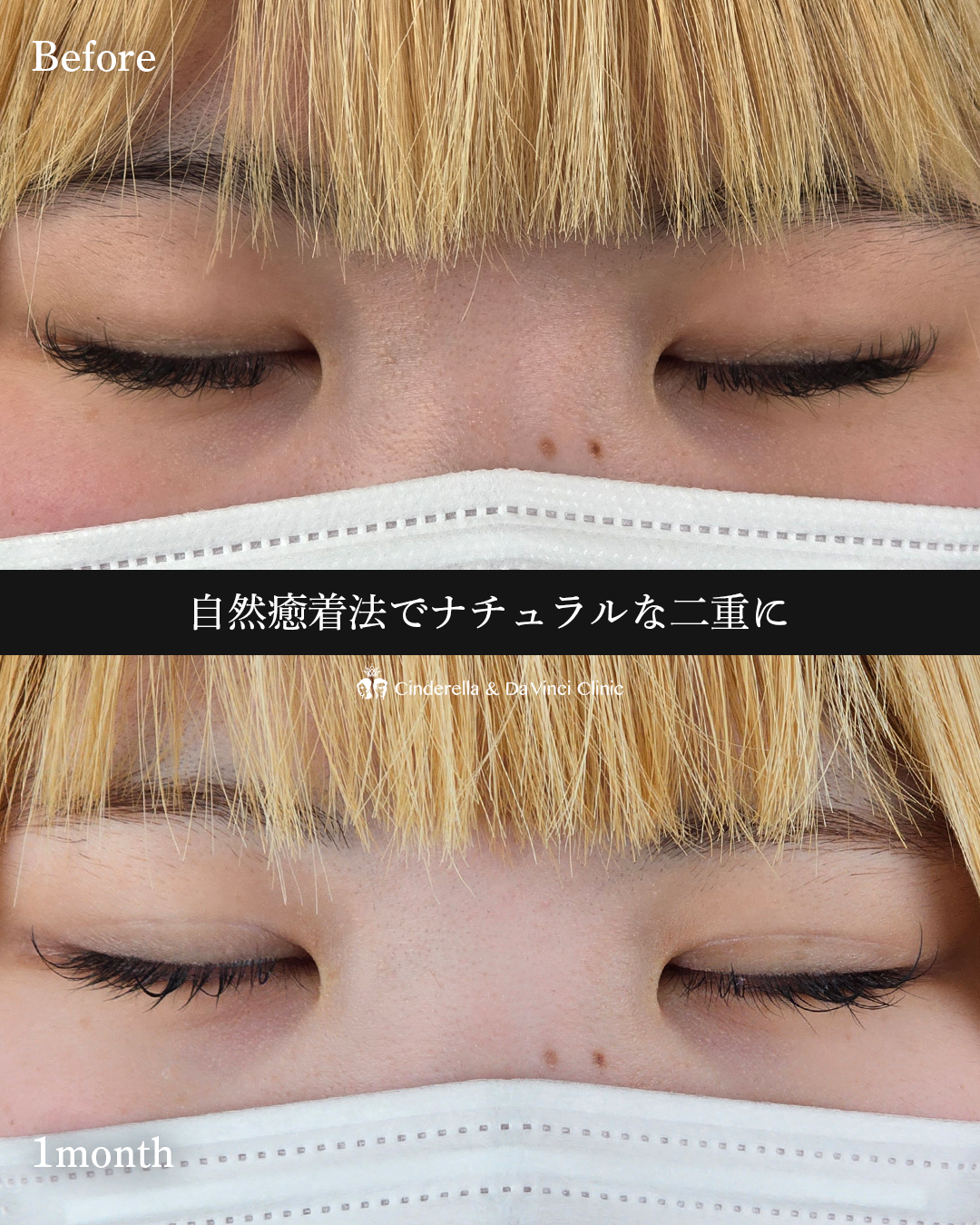 ナチュラル二重の画像