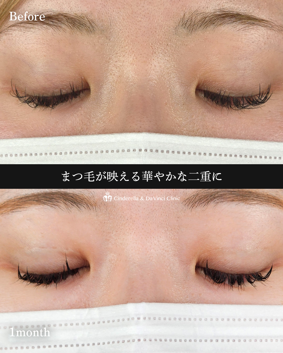 埋没で華やか二重の画像