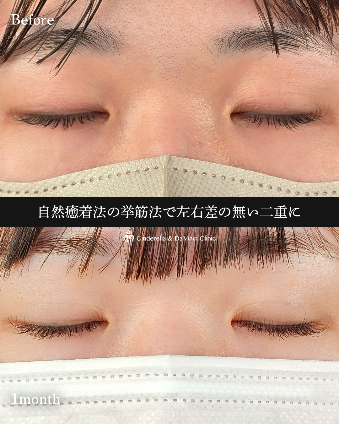 埋没で理想の二重の画像