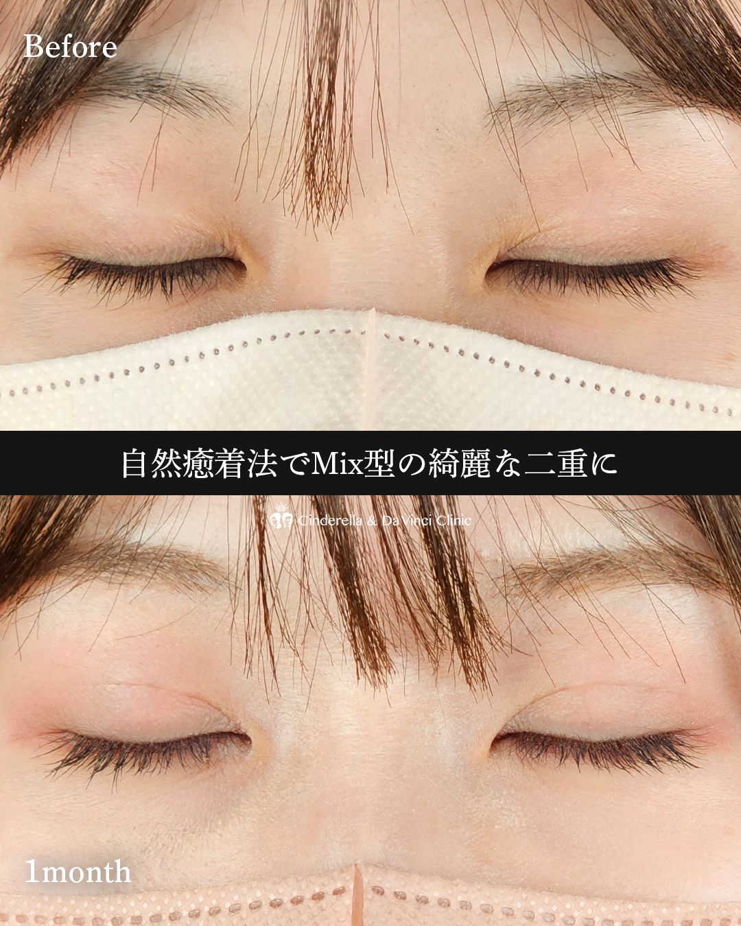 Mix型の二重の画像