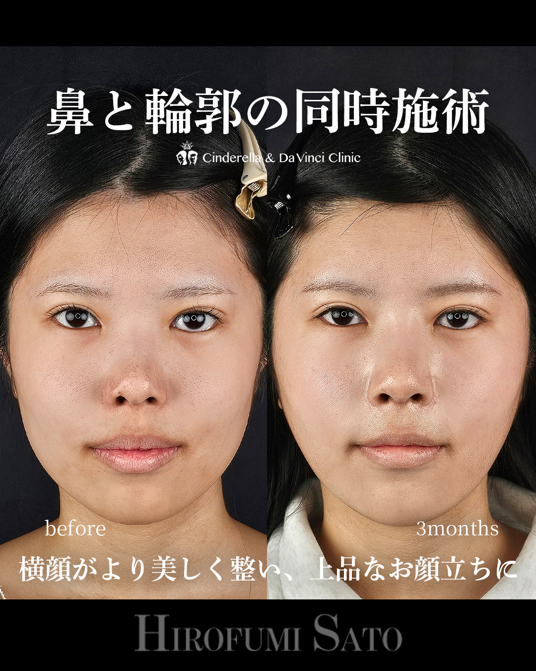 鼻+輪郭の同時施術の画像