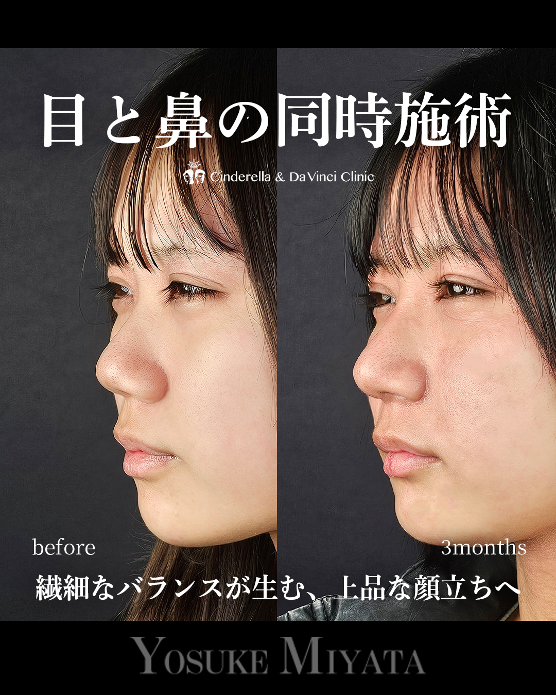 目と鼻の同時施術の画像