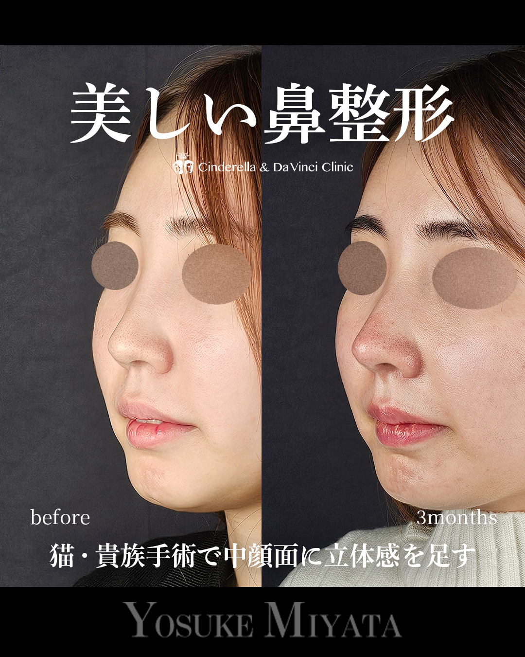 美しい鼻整形の画像