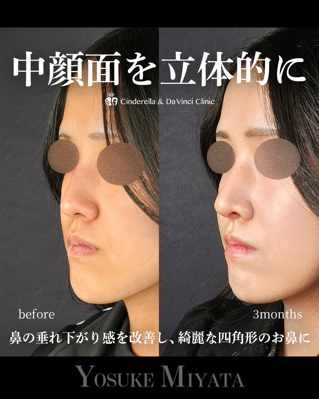 中顔面を立体的にの画像