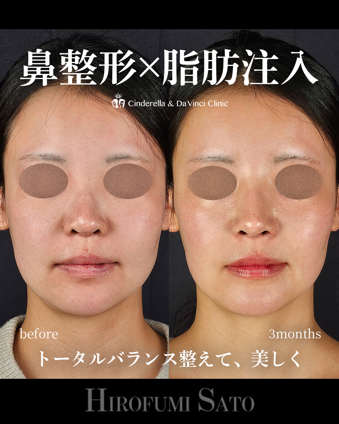 鼻整形と脂肪注入同時の画像